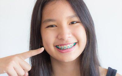 Why Clear Braces are a Popular Choice for Adults